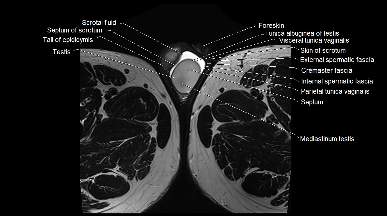MRI 3T scrotum and penis axial cross sectional anatomy image 38.webp